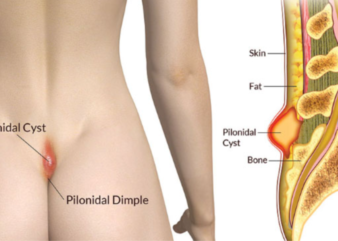 Pilonidal Sinus Medical Illustration